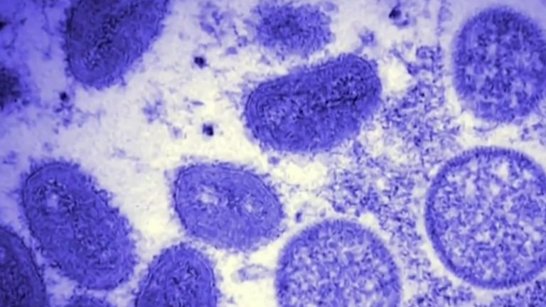 Texas officials report first monkeypox death