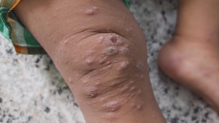 ‘Presumptive’ pediatric case of monkeypox in Harris County ruled false positive, judge says