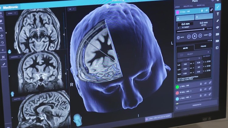 UNT’s Health Science Center gets nearly $150 million to study Alzheimer’s