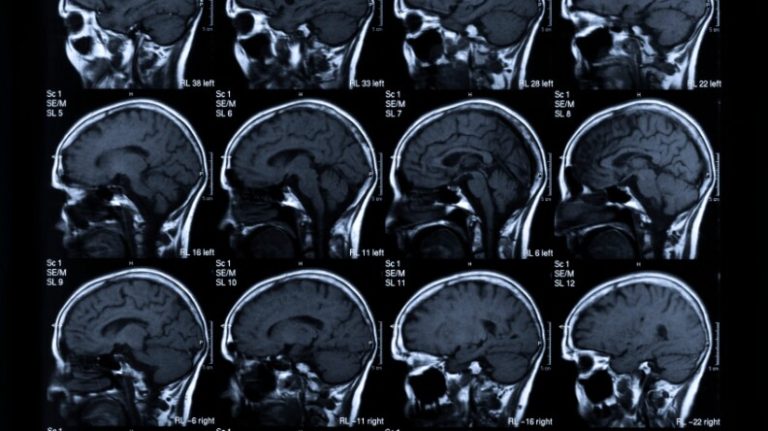 UT Health part of global study exploring genetic indicators of stroke and drug therapies