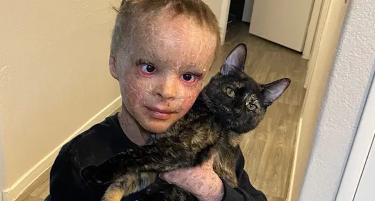 Boy with Rare Skin Condition Can Sleep with Eyes Closed for The First Time in 7 Years