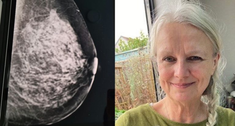 AI Detected Her Early Breast Cancer After Annual Test Came Back as Normal: ‘I feel so lucky’