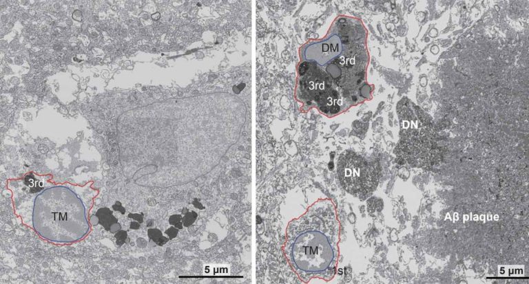 Scientists Make Key Alzheimer’s Breakthrough Identifying Cellular Stress-Related Mechanism Driving the Disease