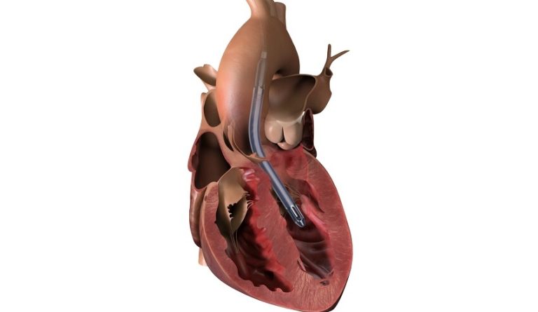 World’s Smallest Heart Pump ‘A Game-changer’ in Keeping Failing Hearts Going Without Major Surgery