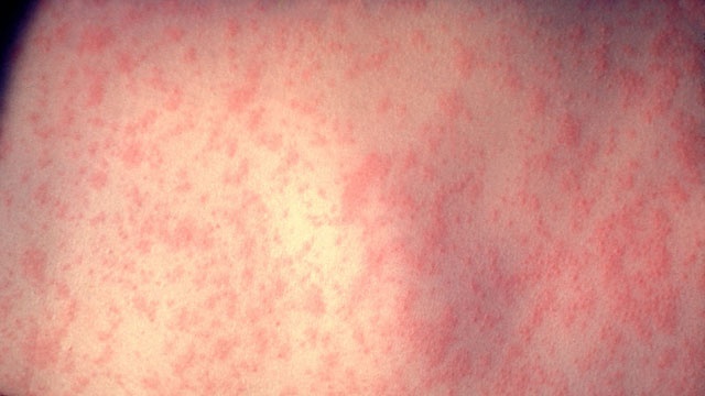 Texas measles outbreak: 90 cases in state as of Friday