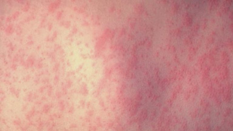 Concern grows for West Texas measles outbreak