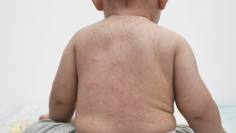 Measles outbreak in West Texas worsens