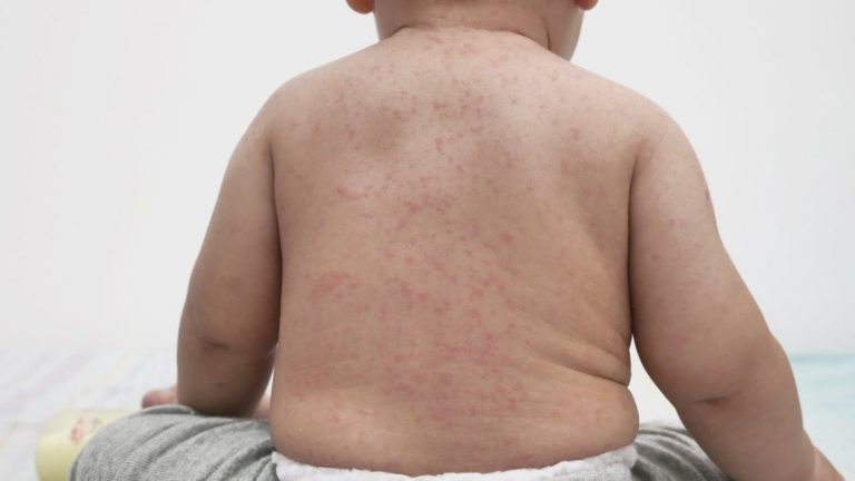 Measles cases double in West Texas outbreak, officials say