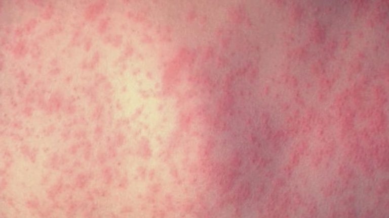 Texas measles outbreak: 90 cases reported in South Plains region